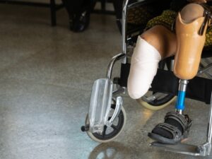 artificial leg below knee price in south africa
